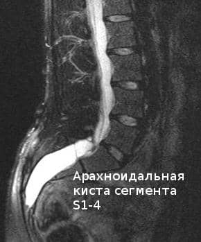 От чего бывает киста на позвоночнике От чего бывает киста на позвоночнике
