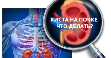 Что делать если обнаружили кисту в почке