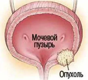 опухоль в мочевом пузыре