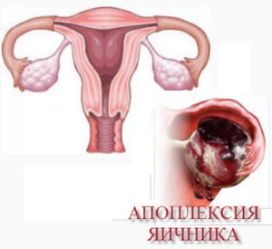 Киста яичника последствия если не лечить у женщин thumbnail