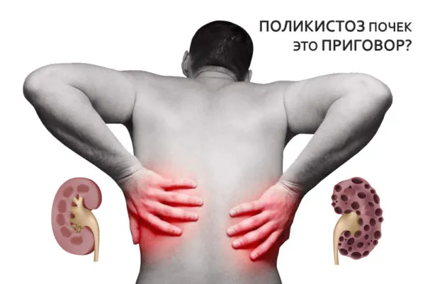 поликистоз это приговор