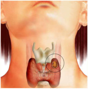 киста щитовидки