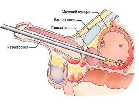 Трансуретральная электрорезекция