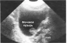 полипы на узи
