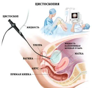 цистоскопия