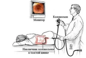 колоноскопия кишечника