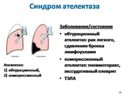 синдром ателектаза