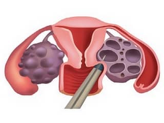 биопсия новообразования яичника. биопсия яичника у женщин. эндометриоз брюшины лапароскопия. лапароскопия цистаденомы яичника. биопсия яичника у женщин.