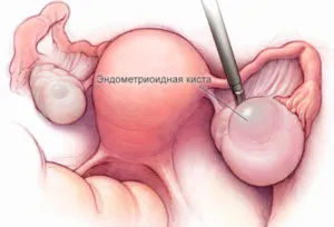опухоль в яичниках