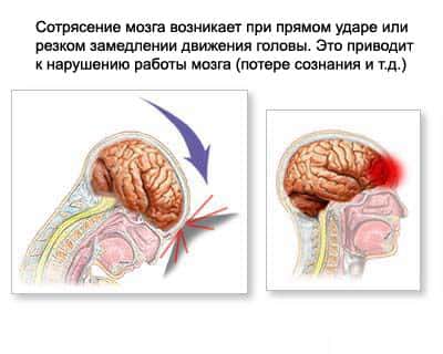 что такое сотрясение мозга