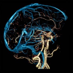 Рентгенография мозга