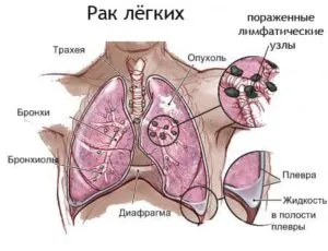 рак легких схема