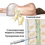Пункция спинного мозга