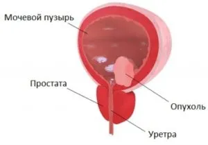 доброкачественная опухоль простаты