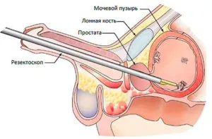 трансуретральная резекция