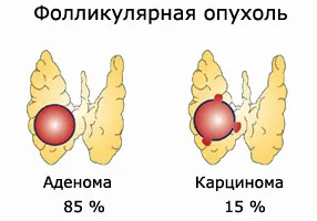 фолликулярная опухоль