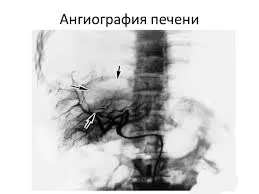 ангиография