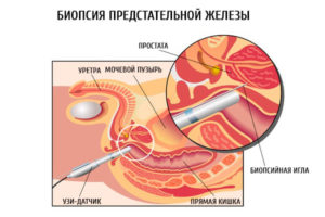 пункция предстательной железы
