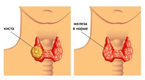 нормальная щитовидка