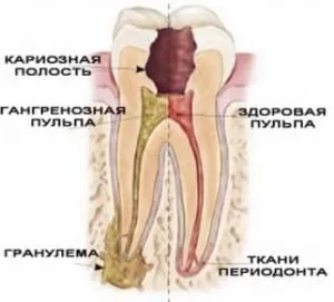 больной зуб