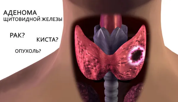 что такое аденома щитовидки