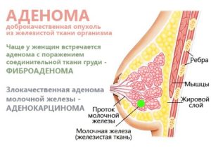 схема груди и аденома