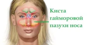 схема кисты в носу