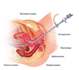 гистероскопия яичника
