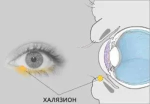 образование на глазу