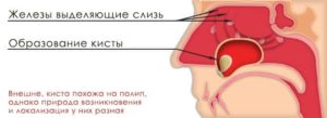 схема кисты в носу