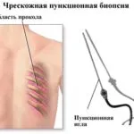 пункция