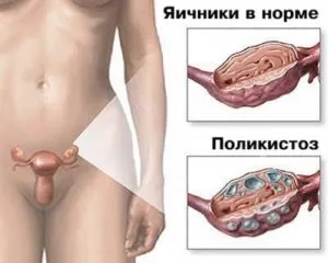 поликистоз яичников