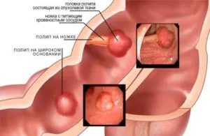 полипы и кисты в кишечнике