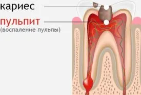 пульпит