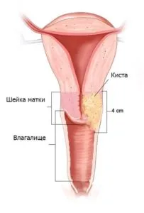 схема кисты на матке