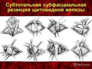 резекция щитовидки