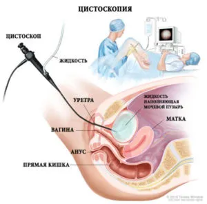 цистоскопия