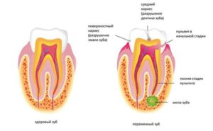 схема кисты зуба