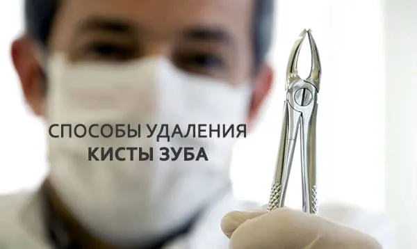 способы удаления зуба