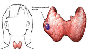 аденома щитовидки