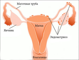эндометриоз у женщин