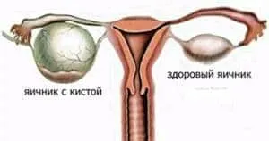 схема кисты
