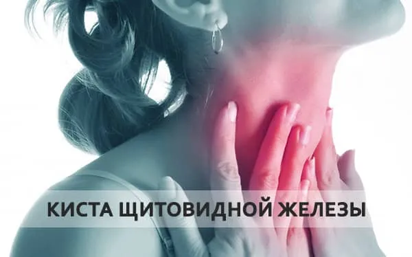 киста щитовидки