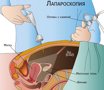 Лапароскопия матки