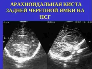 Киста задней черепной ямки на нсг
