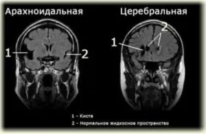 снимок мозга