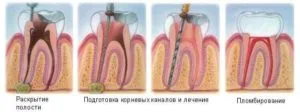 способ лечения зуба