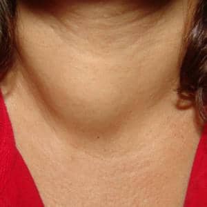 увеличение щитовидки