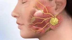 образование в слюнной железе