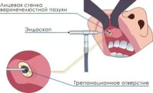 эндоскопия